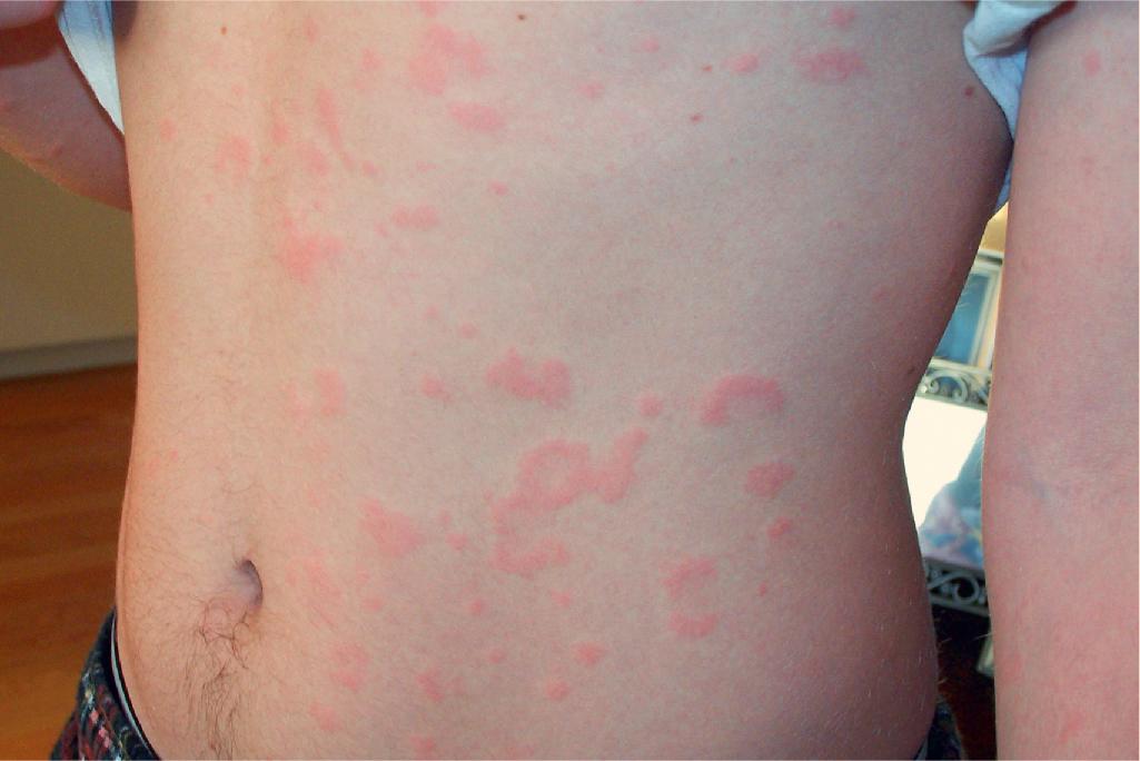 Fig. 20.7, Urticaria. Chronic urticaria in this teenager in association with autoimmune diseases type 1 diabetes and hypothyroidism. He failed to respond to treatment with antihistamines and required systemic corticosteroids and methotrexate for control.