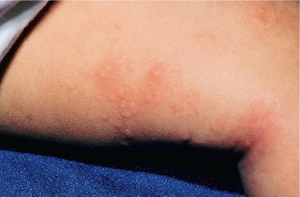 Fig. 20.8, Contact urticaria. Milk dripped on the thigh of this infant, leading to the rapid development of small wheals.