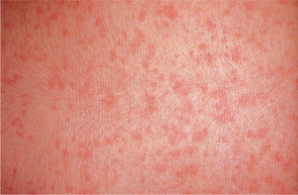 Fig. 20.10, Cholinergic urticaria. Discrete micropapular wheals are surrounded by a wide area of erythema and are induced by heat, exertion, or emotional stress.