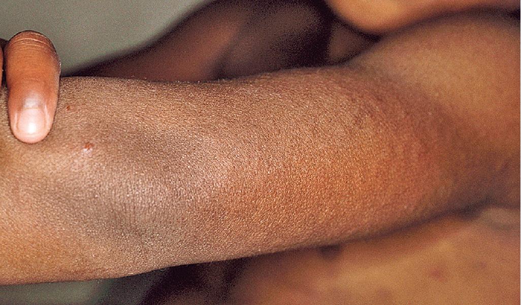 Fig. 20.11, Aquagenic urticaria. Small, intensely pruritic, perifollicular papular wheals with surrounding erythema that occur after contact with water or perspiration, regardless of temperature.