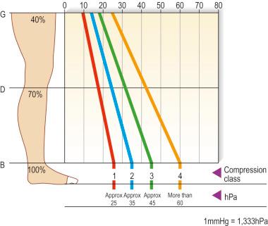 Figure 6.12, Diagram comparing the degree of compression exerted at various locations on the leg with different compression class stockings. B is the pressure generated at the ankle; D is the pressure generated at the knee; G is the pressure generated at the superior thigh. Note that there is a graduation of pressure with all classes of stockings, with the highest pressure exerted at the ankle. Also note that the most significant difference in pressure generated by the different classes of stockings is at the ankle.