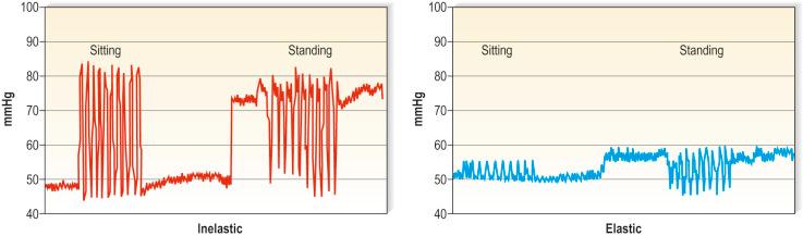 Figure 6.15, Resting and working pressure of an inelastic bandage (left) and an elastic bandage (right), measured at B1. During movement (dorsiflexions in the sitting position, tip-toes in the standing position) the pressure fluctuations are much higher with the inelastic bandage compared with the elastic bandage. By standing up from the sitting position the pressure rises by 23 mmHg under the inelastic bandage, but by only 8 mmHg under the elastic bandage. This increase of pressure characterizes stiffness.