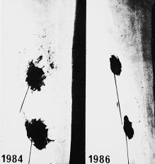 Figure 6.2, Indirect lymphography by subdermal infusion of water-soluble contrast into lipodermatosclerotic skin above the medial malleolus. Before treatment (1984), irregular lymphatics with dermal backflow and extravasation can be seen. After compression therapy, with removal of edema and normalization of the skin changes (1986), normal lymph drainage is obtained.