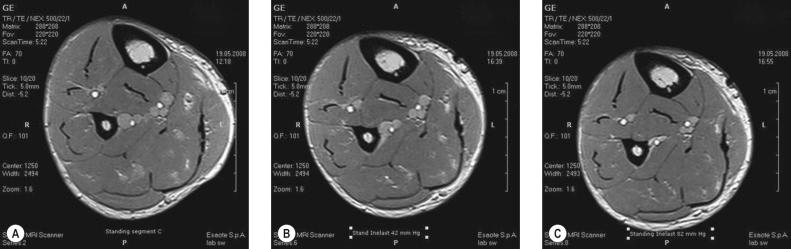 Figure 6.3, Magnetic resonance imaging of a crosssection through the largest calf segment in the standing position. A, Without compression; B, with a short-stretch bandage exerting a local pressure of 42 mmHg; C, with a pressure of 82 mmHg. A diameter reduction of the deep tibial posterior and peroneal veins can clearly be seen with increasing pressure.