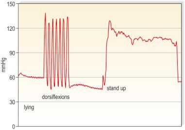 Figure 6.4, Interface pressure measured 12 cm above the inner ankle after application of a tight, zinc paste bandage aiming to produce a very strong bandage. The initial pressure in the lying position (left) is 60 mmHg. Ankle movements performing maximal dorsiflexions produce pressure peaks up to 120 mmHg. By standing up (right) the pressure rises to 100 mmHg. During the next 2 h there was a pressure drop to 25 mmHg in the supine and to 60 mmHg in the standing position.