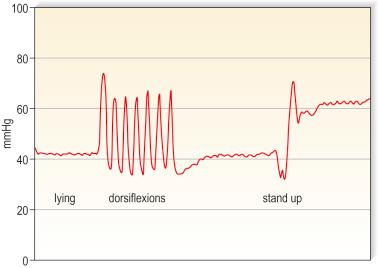 Figure 6.5, Typical pressure curve from the medial lower leg under an inelastic bandage in the supine position (left), with dorsiflexions and after standing up. The resting pressure of 40 mmHg rises to 60 mmHg by standing up. The difference between standing and lying pressure has been termed the static stiffness index (SSI).