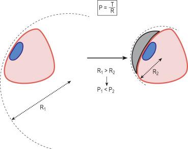 Figure 6.7, According to Laplace's law, the pressure exerted by a bandage is in direct proportional to the radius of the leg. To increase local pressure on flat parts of the lower leg circumference, rubber pads are attached over the area ( black sickle ) to decrease the radius. The oval represents a leg ulcer.