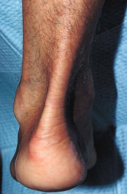 Figure 6.8, Typical appearance of an ankle in posterior orientation. Note the bulging malleoli and the resulting concavity produced on the lateral and medial aspects.