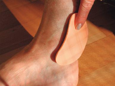 Figure 6.9, A rubber pad put behind the inner ankle increases local pressure. Note that the concave part of the pad is directed towards the skin.