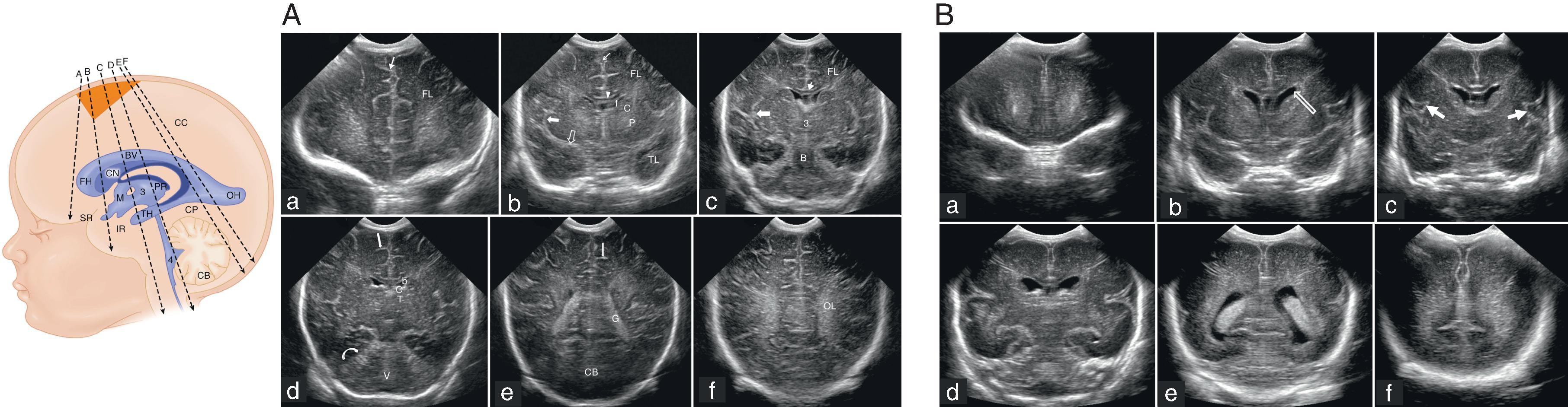 Fig. 95.1, Coronal Brain Ultrasound Planes Through Anterior Fontanelle in a Term (A) and a Preterm (B) Infant .