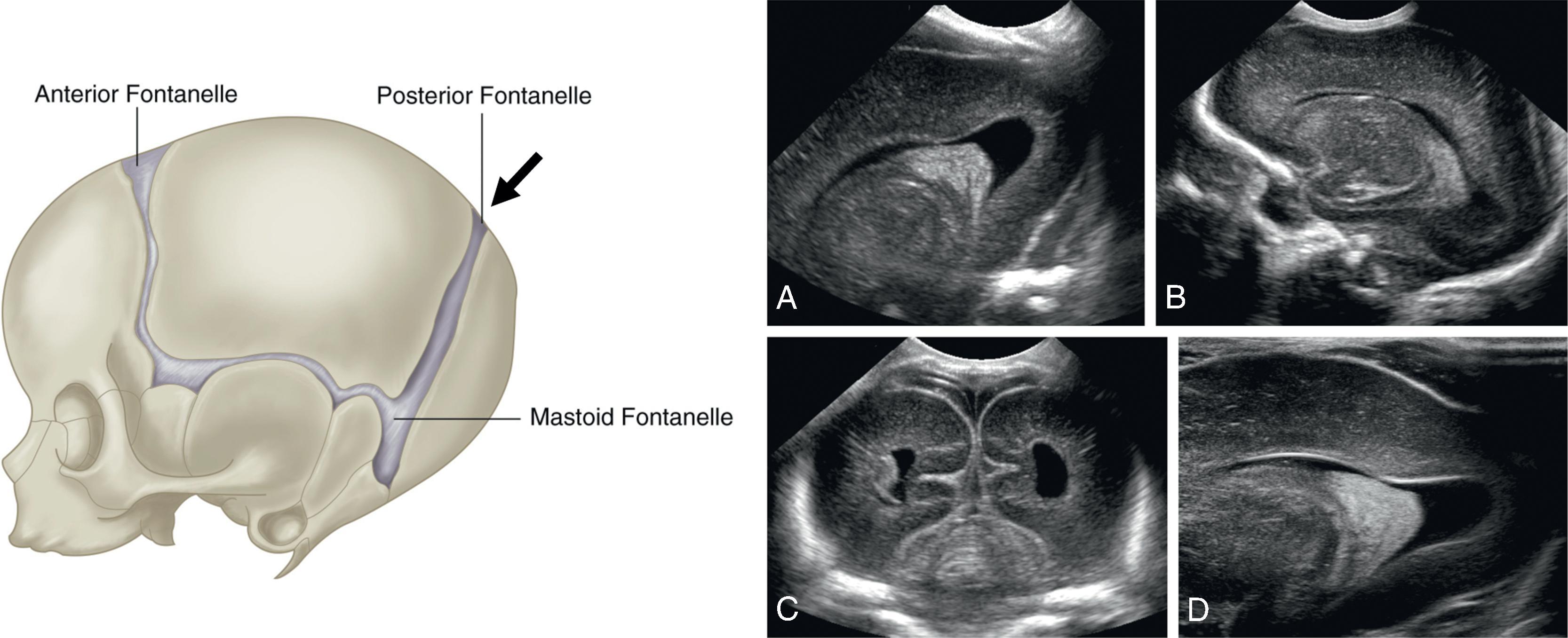 Fig. 95.2, Normal Brain Images of the Occipital Horn Obtained Through the Posterior Fontanelle ( Arrow ) .