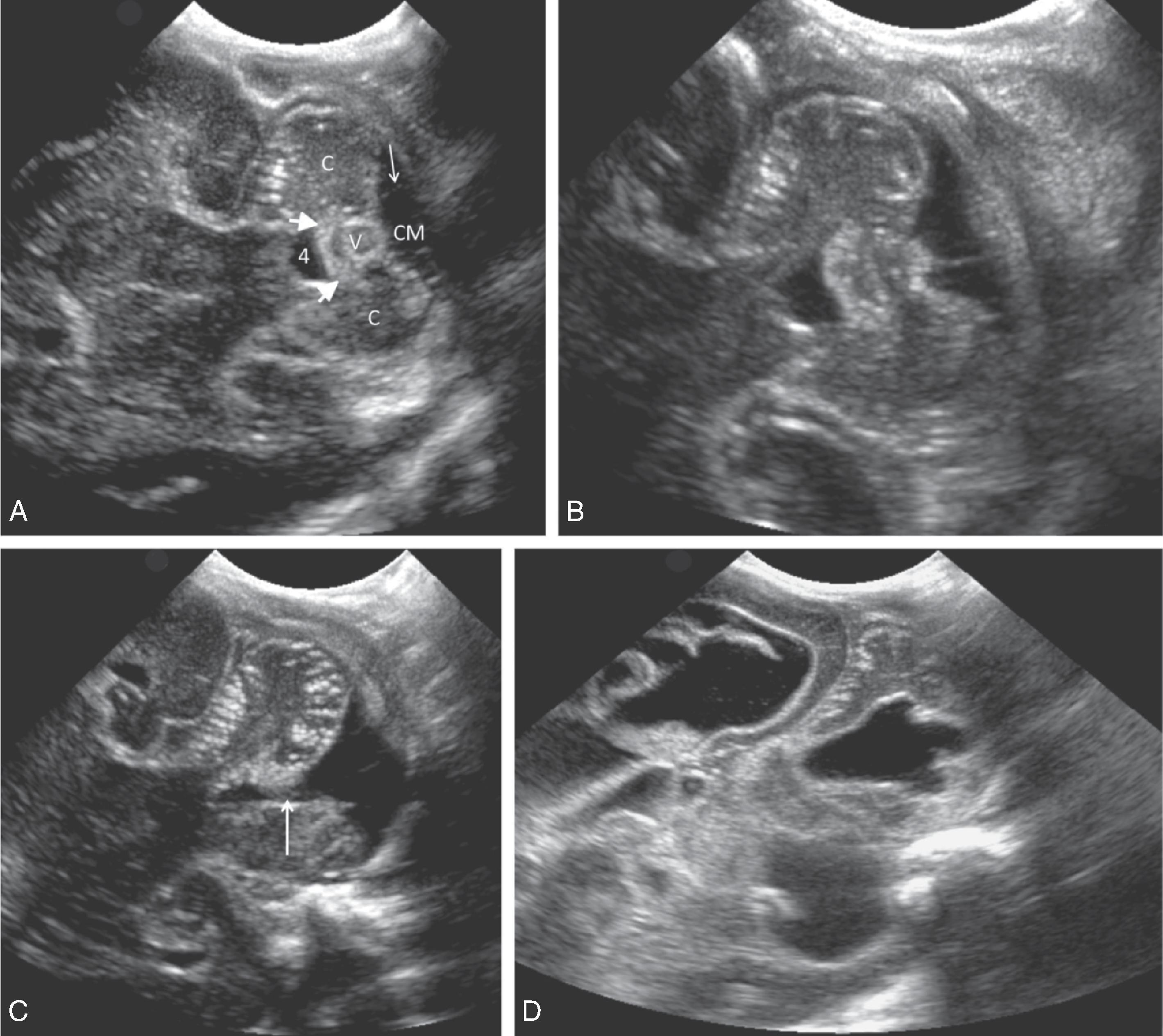 Fig. 95.3, Mastoid Fontanelle Images at the Fourth Ventricle Level in the Posterior Fossa .