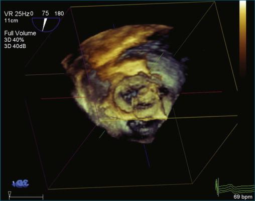 Figure 17-3, Rotating to the aortic valve.