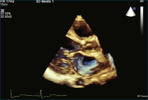 Figure 17-8, Setup view for obtaining full volume of the left ventricle, the left atrium, and the mitral valve.