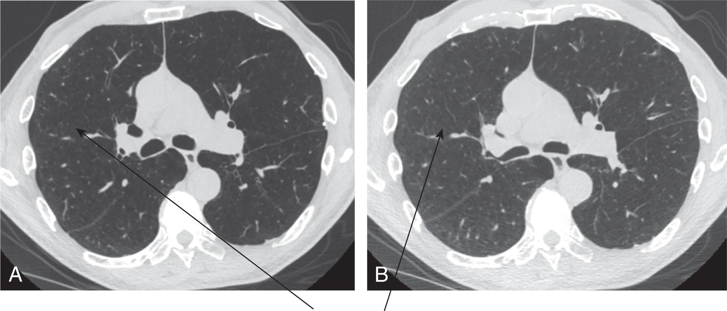Fig. 6.2, Supine inspiratory (TLC) chest CT axial image (A) and supine expiratory (RV) chest CT axial image (B) from a patient with severe COPD (GOLD Stage 4). There is little change in lung density throughout both lungs in B compared to A (arrows in A and B ) . This lack of change in lung density is due to air trapping from obstruction and/or loss of small airways, <2 mm in diameter ( see text ).