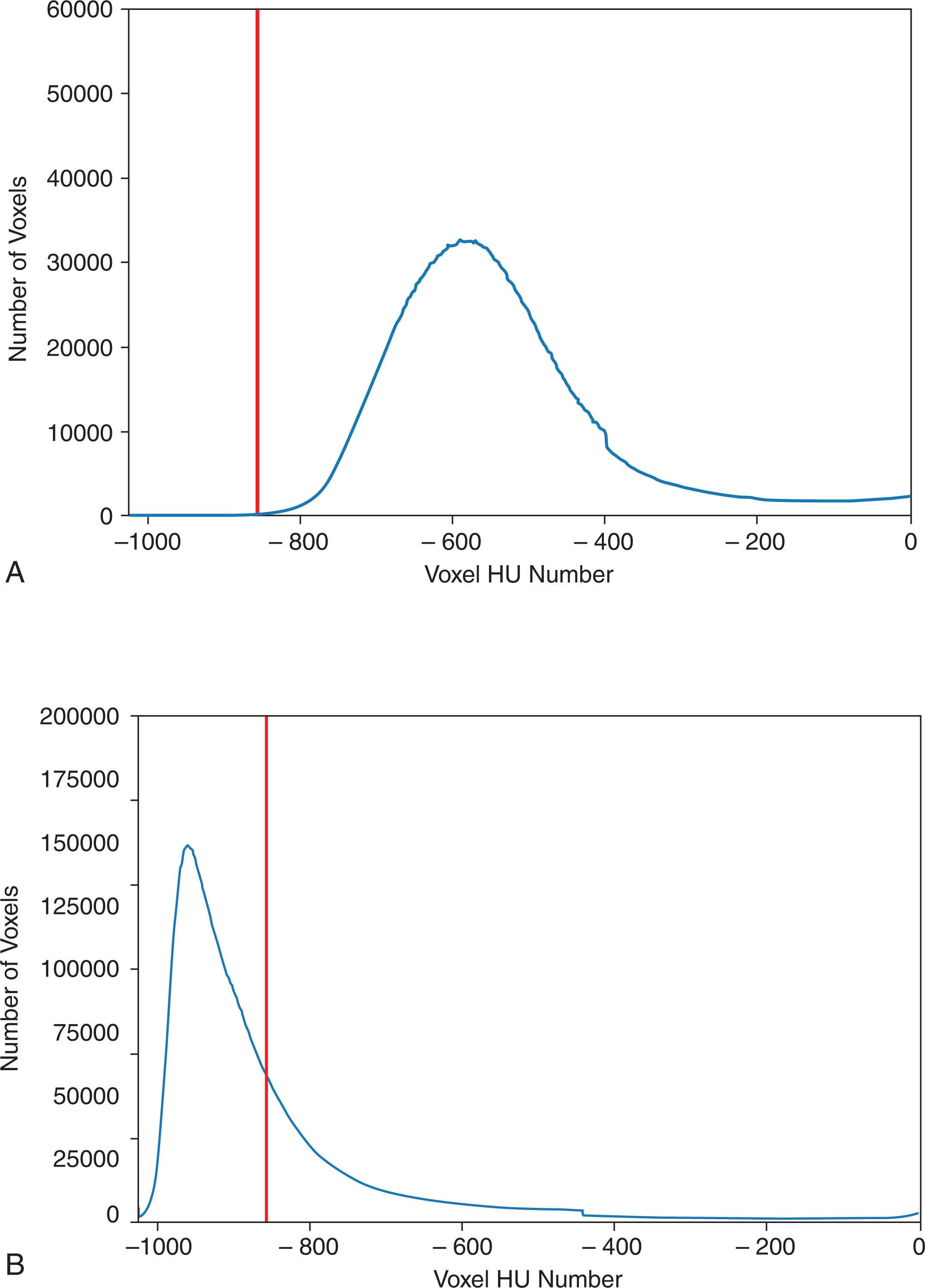 Fig. 6.3, RV lung CT voxel histogram curve taken from a normal patient (A) and a patient with air trapping from COPD (B) . The vertical red lines mark the −856 HU value ( A , LAA −856 = 0.1%, mean lung density (MLD) = −531 HU. B , LAA −856 = 66.7%, MLD = −854 HU).