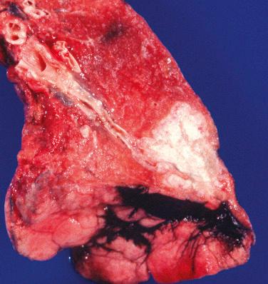 FIG. 26.1, Adenocarcinoma. Lobectomy specimen reveals large, tan/white peripheral mass with lobulated borders adjacent to the pleura.