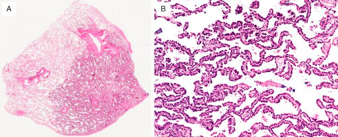 FIG. 26.2, Adenocarcinoma in situ (AIS). (A) Malignant glandular epithelium crawling along the alveolar walls without invasion into the underlying stroma. (B) The bland nonmucinous tumor cells can be difficult to distinguish from reactive pneumocytes.