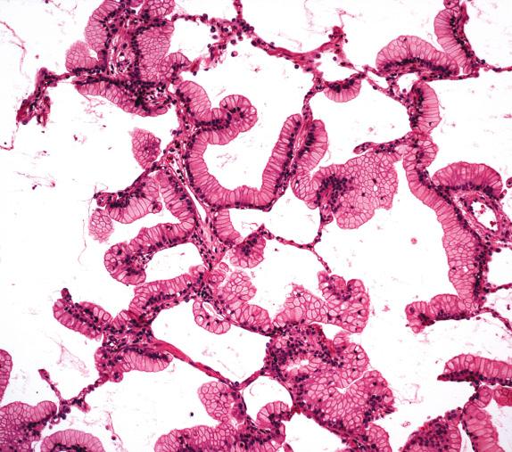 FIG. 26.4, Mucinous adenocarcinoma. Mucinous lepidic adenocarcinoma with tall, columnar cells with abundant mucin in cytoplasm.