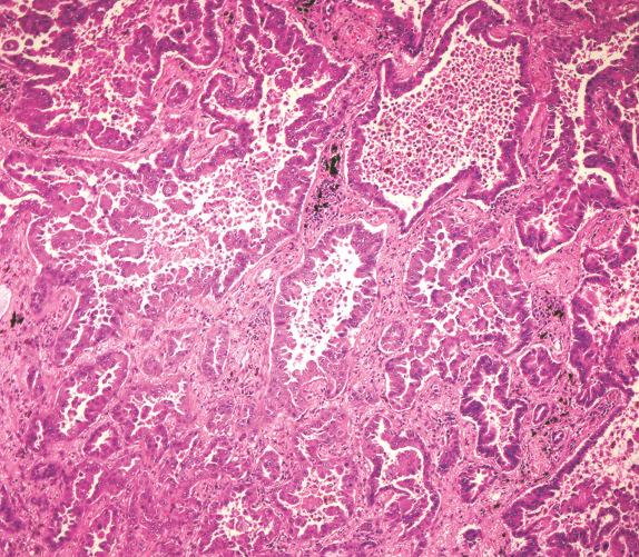 FIG. 26.6, Adenocarcinoma. Acinar type of adenocarcinoma reveals malignant glands infiltrating through collagenous stroma.