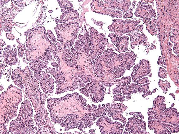 FIG. 26.7, Decapitated papillary structures floating in the alveolar spaces, with fibrovascular cores, characteristic of papillary pattern.