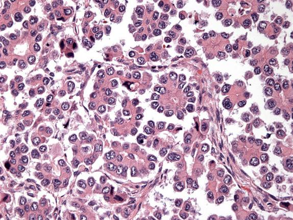FIG. 26.8, Another example from a nonsmoking woman of Taiwanese descent, patient with adenocarcinoma. No fibrovascular cores were present.