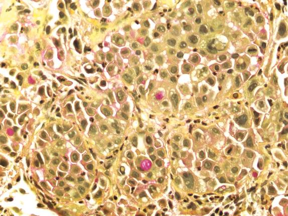 FIG. 26.9, Adenocarcinoma. Solid type of adenocarcinoma with a mucicarmine stain that highlights intracellular mucin in neoplastic cells.