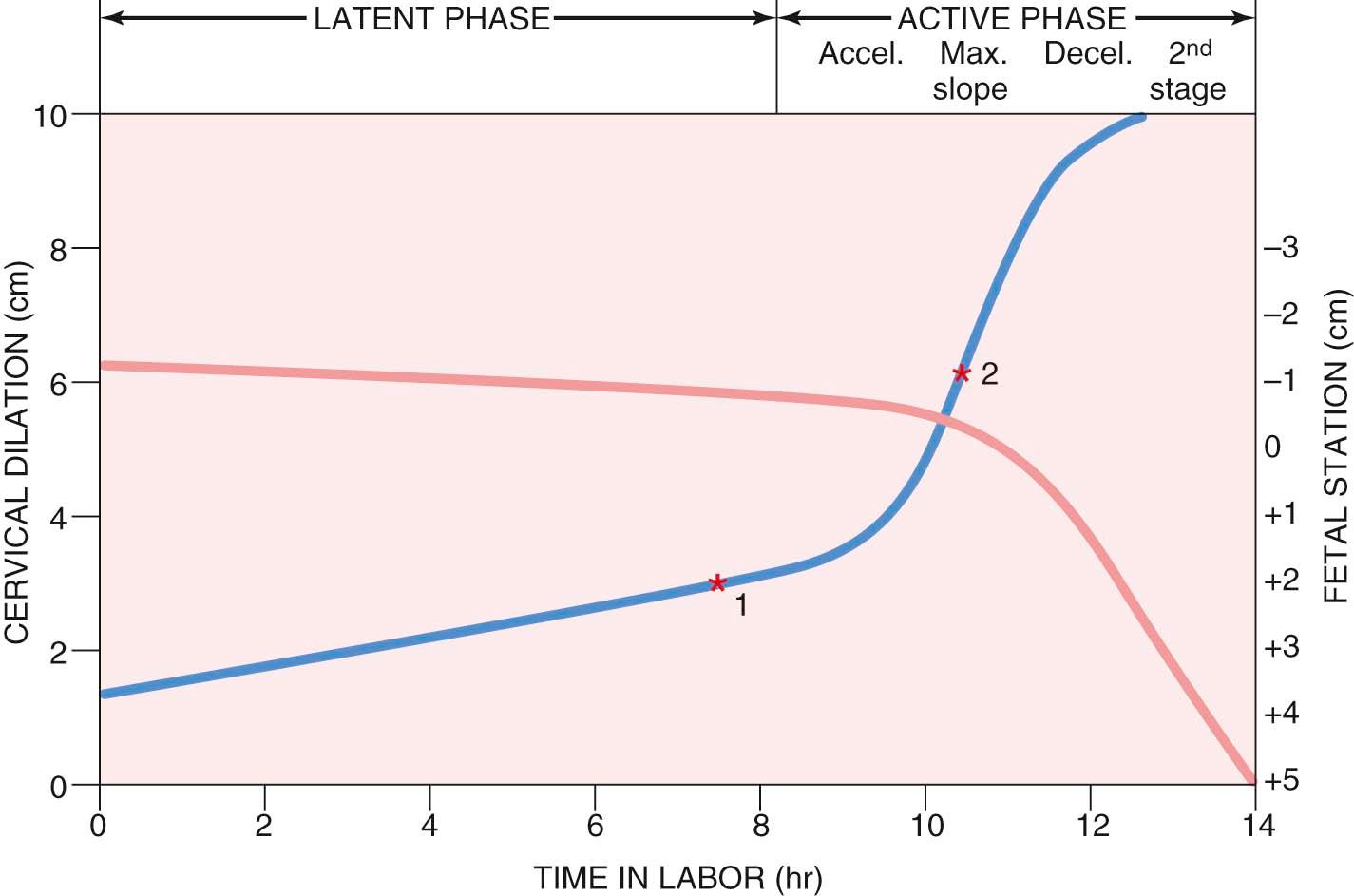 FIGURE 11-1, Graphic plot of cervical dilation (blue) and descent of the fetal presenting part (red) during labor. Red star 1 on the blue line indicates the beginning of the active phase of labor (as recommended by Cohen and Friedman) and red star 2 the beginning of the active phase of labor as recommended by Zhang et al.