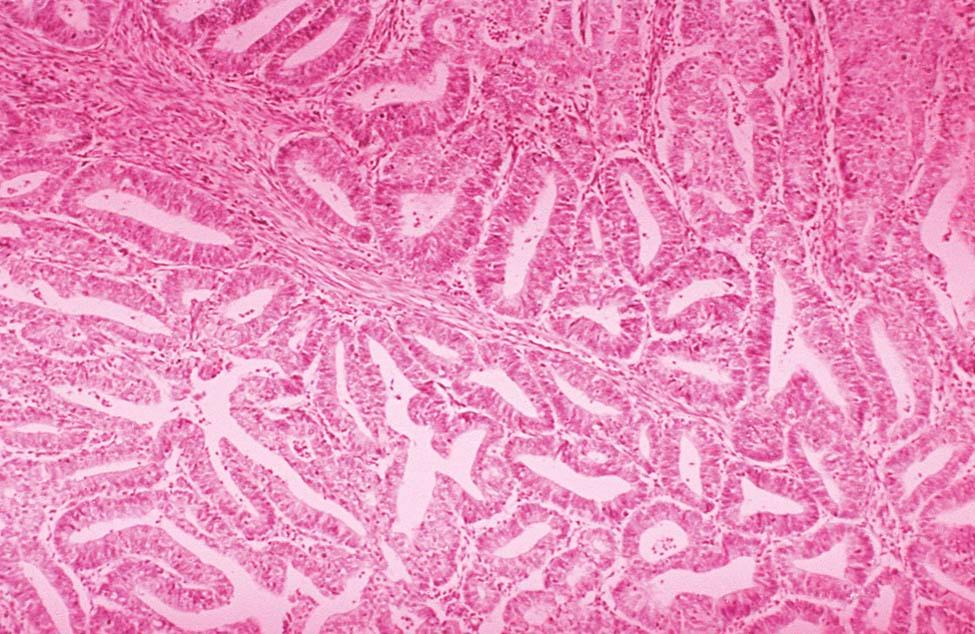 FIGURE 41-1, Well-differentiated endometrial adenocarcinoma. Note the back-to-back glands with minimal intervening stroma and the gland-within-gland pattern.