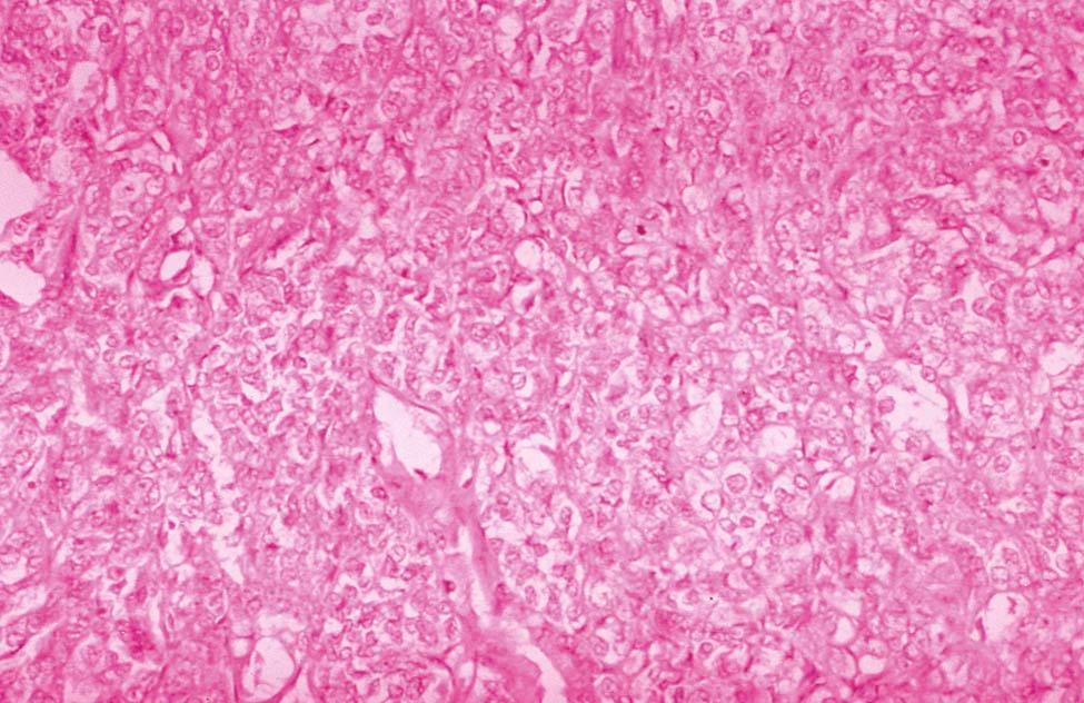 FIGURE 41-2, Poorly differentiated endometrial adenocarcinoma. Note the predominantly solid nature of the tumor with minimal gland formation.