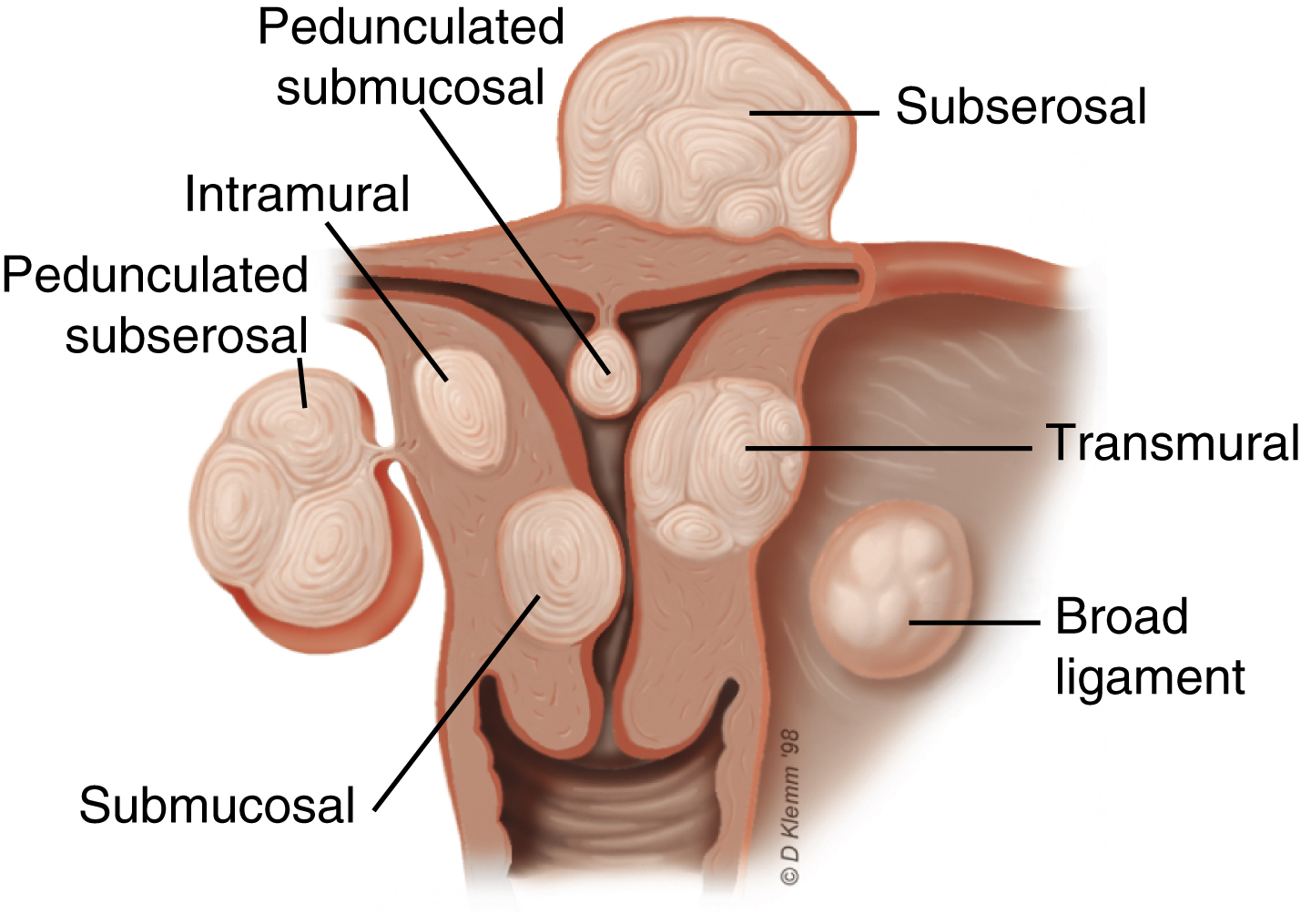 Fig. 43.1, Types of uterine leiomyomas.
