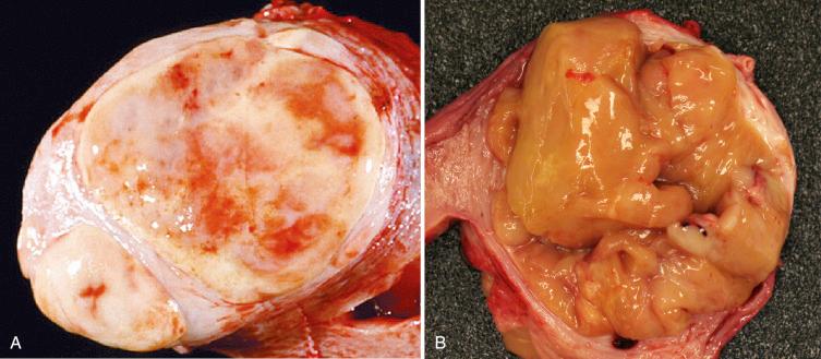 Fig. 20.1, Endometrial stromal nodule. A, This tumor is bilobate and has areas of smooth muscle differentiation, which are apparent as the tan areas within the distinctive yellow appearance of the neoplastic stroma. B, Central cystic degeneration can sometimes occur, and the tumor can extrude on cut section. Note the sharply circumscribed border.