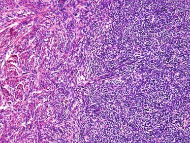 Fig. 20.11, Mixed endometrial stromal–smooth muscle tumor. Imperceptible merging of neoplastic stroma with areas of smooth muscle differentiation is shown.