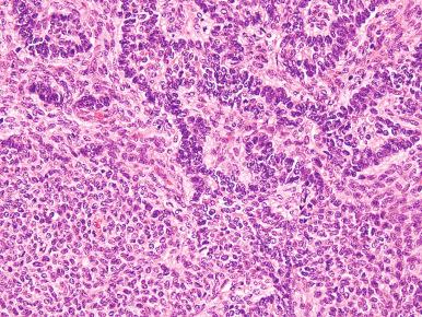Fig. 20.12, Endometrial stromal sarcoma, low grade. Ovarian sex cord–like differentiation is shown.