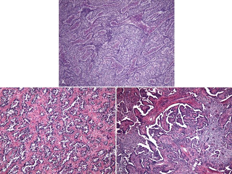 Fig. 20.13, Uterine tumor resembling ovarian sex-cord tumor. These tumors can closely resemble ovarian granulosa cell tumors (A), Sertoli cell tumors (B), and sex cord tumors with a retiform growth pattern (C) .