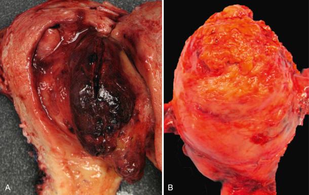 Fig. 20.15, Endometrial stromal sarcoma, high grade. A, The tumor typically forms a polypoid intracavitary mass; note the extensive hemorrhage. B , Involvement of the serosa and high-stage disease are common.