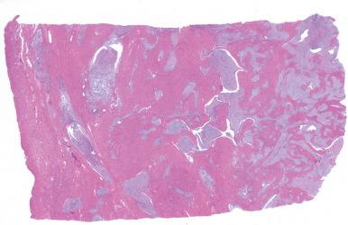 Fig. 20.16, Endometrial stromal sarcoma, high grade. The tumor shows extensive permeative infiltration of the myometrium, with extension into vascular spaces.