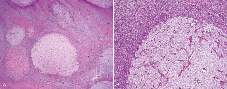Fig. 20.18, Endometrial stromal sarcoma, high grade. A, The biphasic growth can be appreciated on low-power examination. B, Transition from the morphologically low-grade to high-grade component.