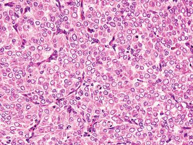 Fig. 20.20, Endometrial stromal sarcoma, high grade. In the morphologically high-grade areas, the tumor cells appear epithelioid, with more abundant cytoplasm. Note the larger, more vesicular nuclei, mitotic activity and karyorrhexis.