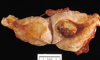 Fig. 20.21, Undifferentiated uterine sarcoma. Tumors typically appear as a polypoid intracavitary mass.