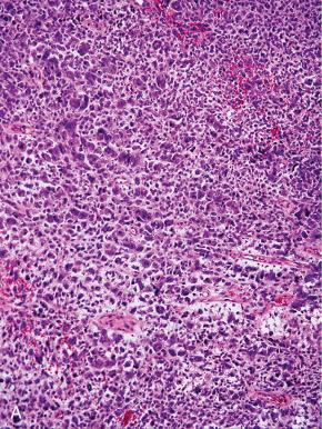 Fig. 20.23, A, Undifferentiated uterine sarcoma may appear histologically similar to areas of high-grade leiomyosarcoma (B) and poorly differentiated carcinoma (C) .