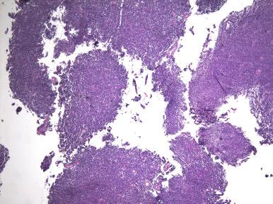 Fig. 20.25, Endometrial stromal neoplasm. Multiple fragments of aglandular cellular stroma indicate a stromal neoplasm.