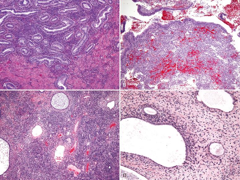 Fig. 20.26, Differential diagnosis of an endometrial stromal neoplasm in a curetting. A, Endometrial basalis. Note the orderly glandular component. B, Aglandular functionalis. C, Cellular stroma-rich endometrial polyp. Note the prominent vessels and cystic glands, which are characteristic of polyp. D, Müllerian adenosarcoma. Periglandular cuffing and atypical stromal cells are characteristic.