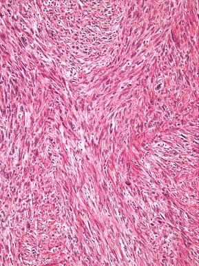 Fig. 20.29, Leiomyosarcoma. A, Typical histologic appearance with diffuse CD-10 positivity (B) .