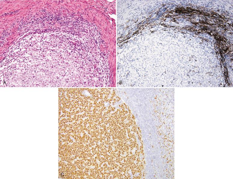 Fig. 20.30, Endometrial stromal sarcoma, high grade. A, B , CD-10 is positive in the morphologically low-grade but not high-grade component. C, Strong diffuse cyclin D1 in the morphologically high-grade component.