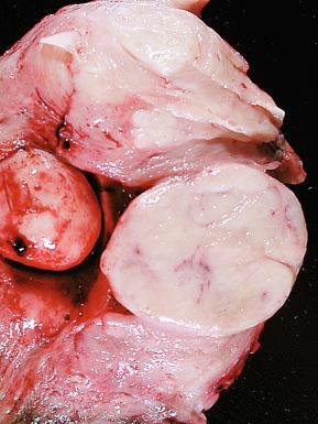 Fig. 20.31, Typical macroscopic appearance of leiomyomata of the usual type. A submucosal leiomyoma protrudes into the endometrial cavity (left). Several intramural leiomyomata have firm, white, incised surfaces that bulge out from the myometrium.