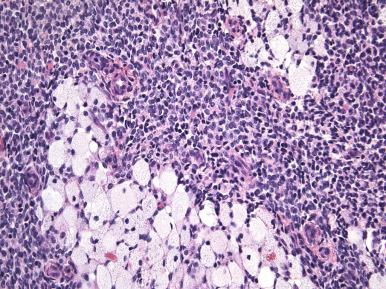 Fig. 20.4, Endometrial stromal nodule. Foamy cells are a characteristic feature.