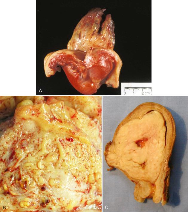 Fig. 20.5, Endometrial stromal sarcoma, low-grade. Tumors may primarily appear as an intracavitary polypoid mass (not the surface hemorrhage and necrosis); (A) , numerous soft yellow tan nodules permeating the myometrium (B), or a combination of these features (C) .