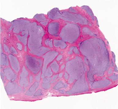 Fig. 20.6, Endometrial stromal sarcoma, low grade. Tumor permeates the myometrium in a finger-like pattern of growth.