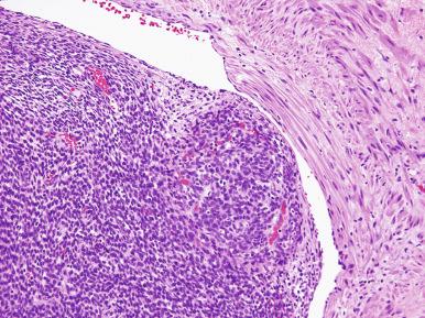 Fig. 20.7, Endometrial stromal sarcoma, low grade. Shown is vascular invasion.